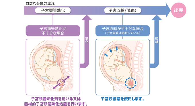 図：分娩誘発の方法